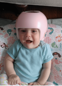 torticollis baby wearing helmet