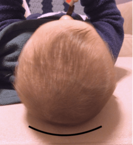 torticollis_infant_flat head