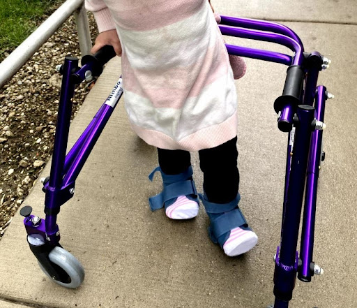 child with walker and serial casts on both feet
